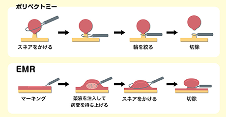 大腸 カメラ ポリープ セール 切除 保険